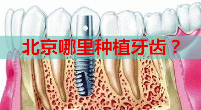 北京哪里种植牙