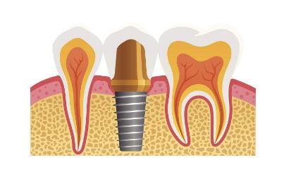 种植牙