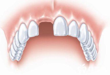 门牙掉了一颗怎么办