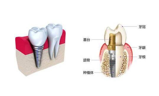种植牙
